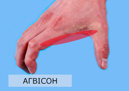 Аркова долоня в Тхеквондо
